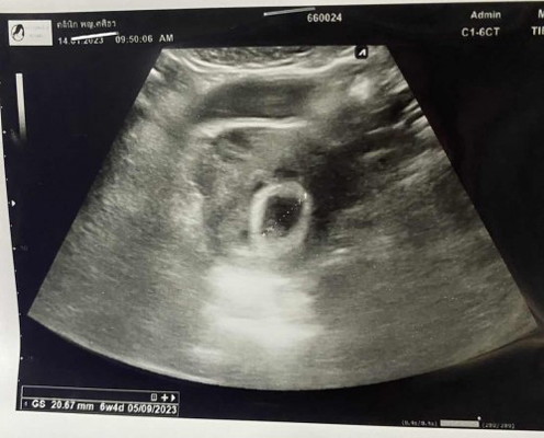 แบบนี้จะเป็นท้องลมมั้ยคะ ท้อง2ค่ะ