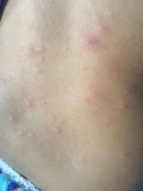 ขอถามผู้รู้หน่อยค่ะ หรือแม่ๆบ้านไหนที่ลูกเคยเป็น