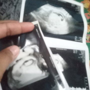 Usia 8 week 1 hari. Usg 2 kantong 1 bayi,