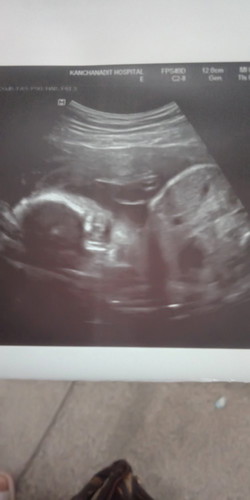 สวัสดีค่ะแม่ๆ28วิค+5วันอันตราเซาวมาสองครั้งแล้วคุณหมอยังไม่เห็นเพศเลยค่ะ ใครพอจะดูออกบ้างค่ะ