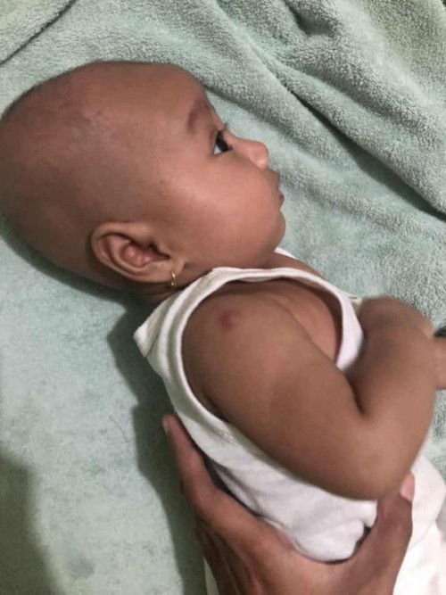 Bisul bekas BCG baru muncul