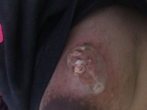 NagkaMastitis din po ba kayo?