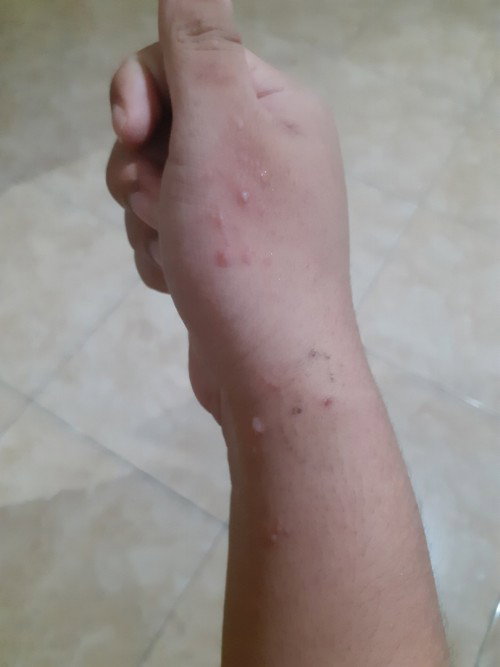 Bentol di tangan bekas infus
