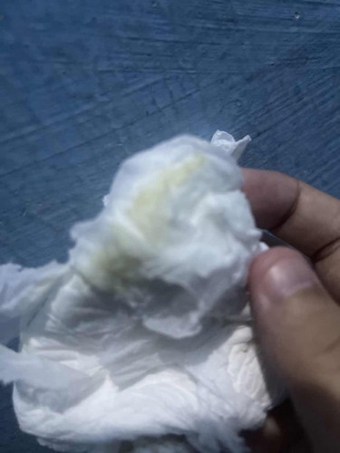 Bun mau nanya 34 week ditisu ada keputihan warna kuning ga ada baunya