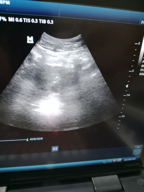 Usg usia 6 minggu 3 hari