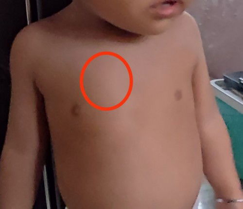 Tulang dada kanan lebih menonjol