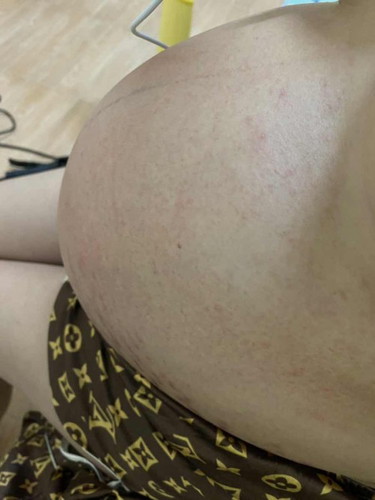 35+3week เป็นผื่นที่ท้อง