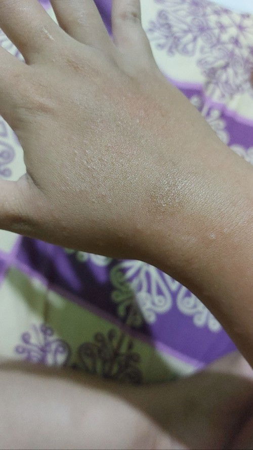 Gatal pada tangan di malam hari