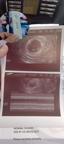 Baby no.2 is on the way.
unexpected to dahil may pcos ako at 1 yr na ako wala menstruation 💕