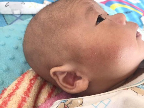 แบบนี้ใช่กากน้ำนมมั้ยคะ แล้วรักษายังไง