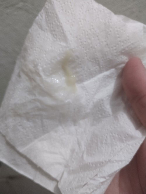 39 weeks and 1days ganito ba itsura ng mucus plug?