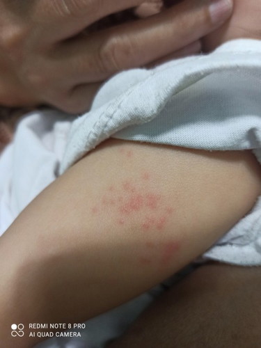 Ask ko lng po ano po ba tong nsa balat ni lo ko insect bite, rashes, skin allergy or kating lamig ?