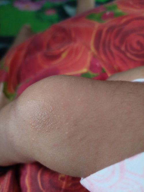 Bintik- bintik pada kaki bayi