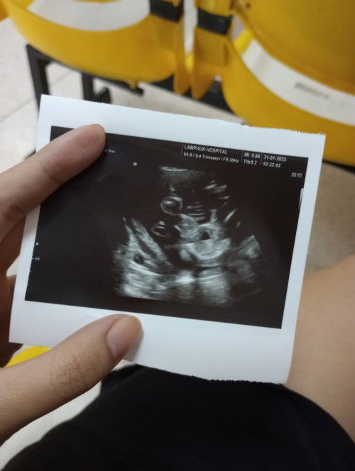 ตอนนี้ 21 วีค หมอบอก ผู้หญิง 90% เพราะไม่มีอะไรโผล่มา  อยากทราบว่ามีสิทเปลี่ยนชายมั้ยคะ แม่ลุ้นชาย