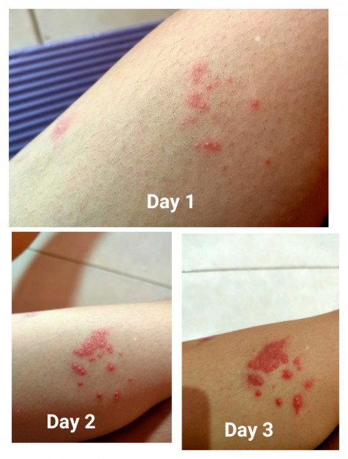 Hamil 8bulan kena herpes