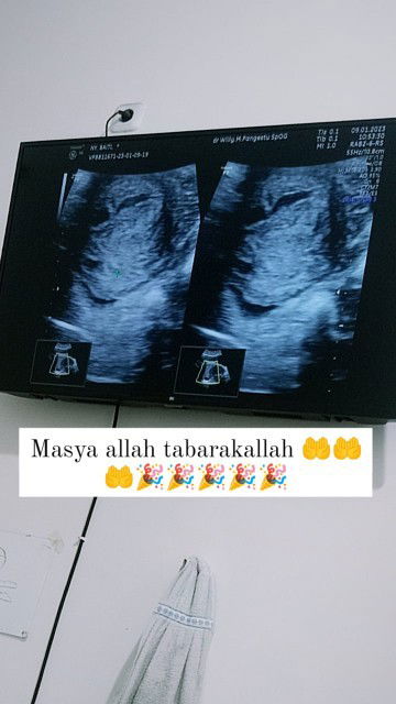 9week janin gak ada difonis hamil bo dan harus dikuret