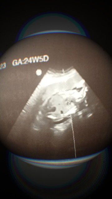 Ultrasound