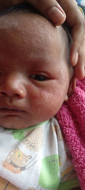 ทำให้ผื่นหาย