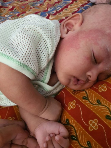 Ruam bayi