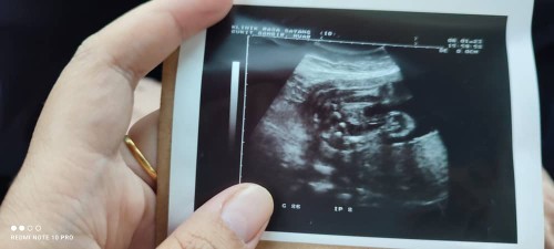 Assalamualaikum.. pinjam mata ibu2 kalau nampk dari scan ni boy ke girl? Tq