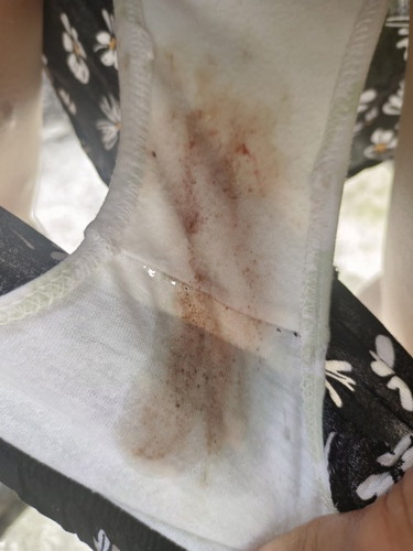 Mommies nag i e skin ob ko knena at nilagyan ako 4 primerose may lumabas skin mga brown ano po un?