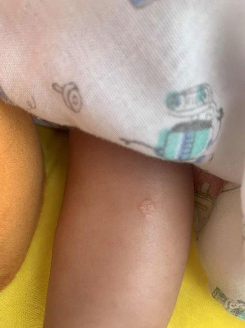 ผื่นลูกขึ้นบริเวณหัวและใบหน้าขาอีก1จุด