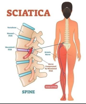 ad tak ibu2 yg sdg atau pernah alami sakit saraf sciatica ni...proses bersalin nnti mcm mne yeđđ
