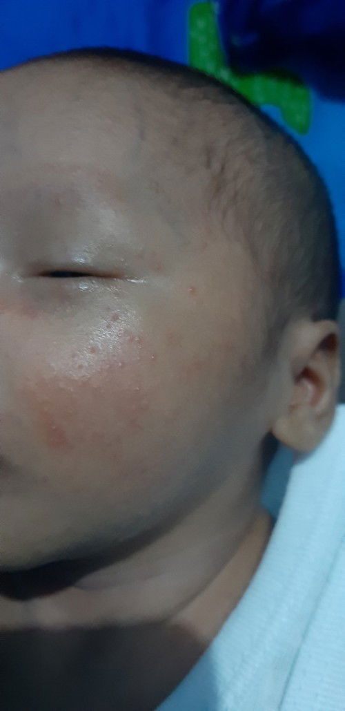 Bintik² merah di area muka bayi