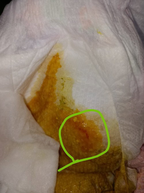 Mga mommies ask ko lng Po kng dugo ba ito sa diaper Ng baby ko?
2mos old by breastfeeding