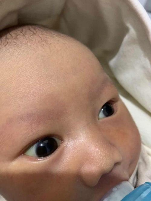 Mata bayi agak kuning