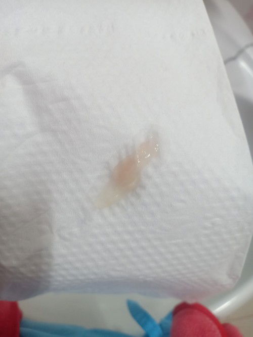 มีมูกไหลออกจากช่องคลอด