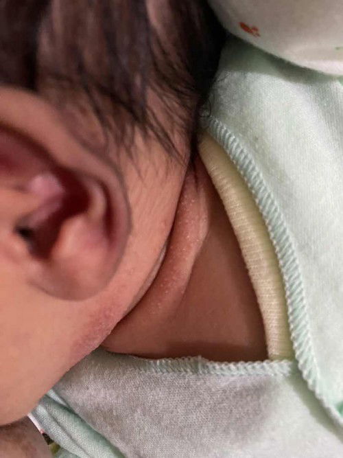 Bintik Merah dileher