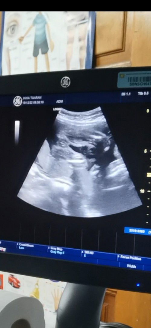 Nak tahu scan baby