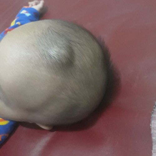 Benjolan di atas dahi