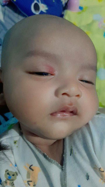 Kelopak mata bayi merah