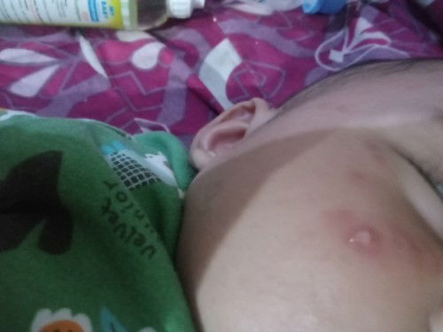 Bunda bunda mau tanya dongg, baby cream yg bagus untuk pipi merah berair seperti itu🙏