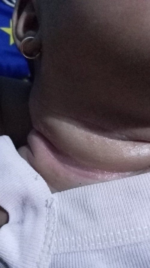 Lehernya lecet merah gitu