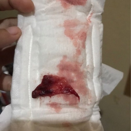 Keluar lendir saat flek