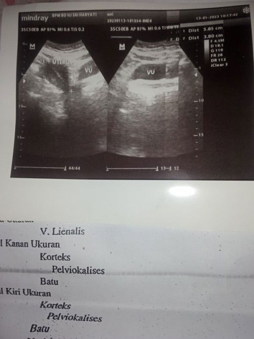 Di Tespek garis 2 tapi di USG tidak ada kehamilan