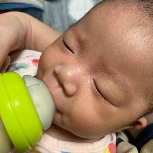 ผื่นขึ้นที่หน้าน้อง