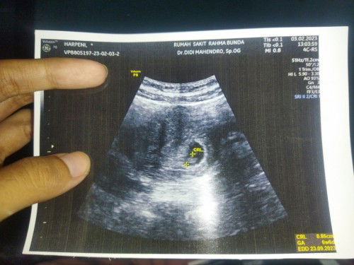 Janin ttp sehat meski pendarahan