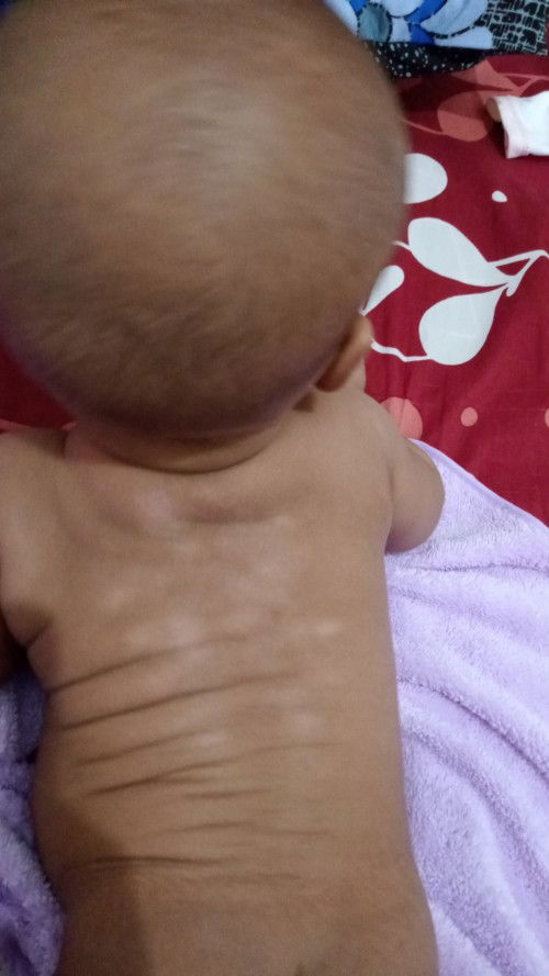 Putih2 di punggung dan dada