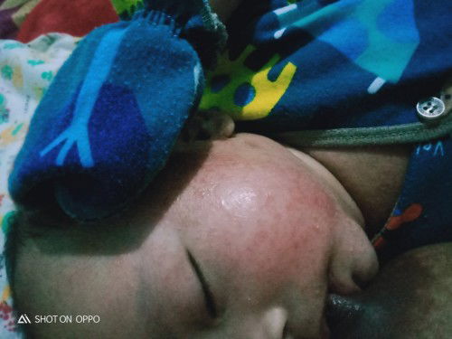 Bun pipi anak aku awal nya bintik2 trus ada airnya aku pkein sabun lactacyd buat mandi jd kering gni