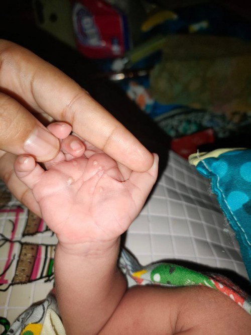 Muncul cairan berisi nanah di tangan