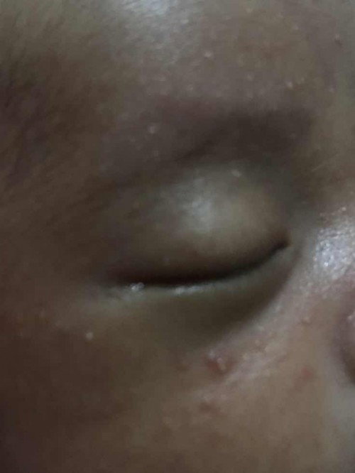 Bintik bintik di wajah bayi kenapa? Dan gimana cara mengatasinya bunda?