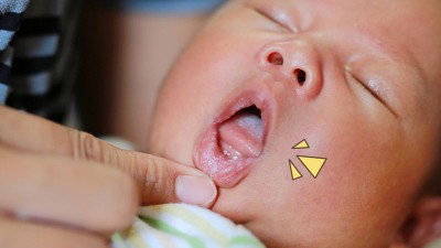 Bayi Sariawan