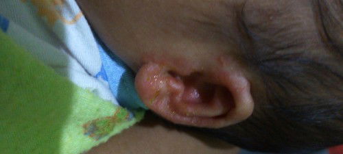 Telinga berkerak kuning