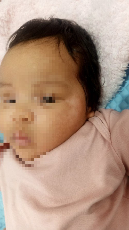 Ruam putih di wajah bayi. Seperti panu