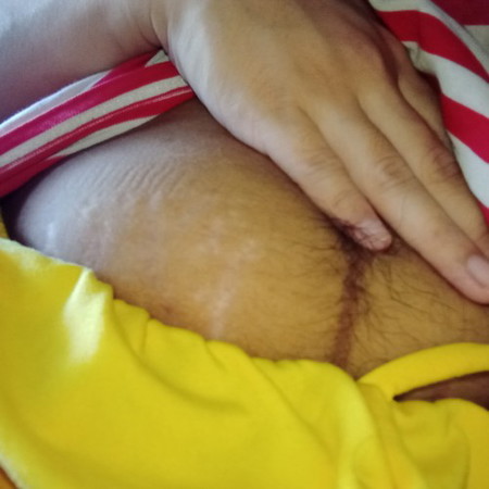 Stretchmark and linear negra