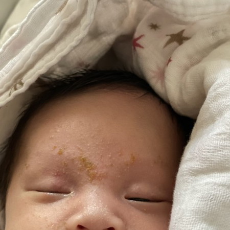 How to treat newborn acne